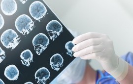 Molecular Markers: Fingerprinting Brain Tumors