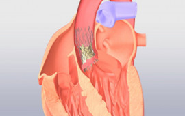 National Heart Valve Disease Awareness Transcatheter Aortic Valve Replacement (TAVR) The Revolutionary Catheter Technique for the Heart Valve Disease