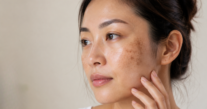 Targeting Stubborn Pigmentation: How the Alma Q-Switched Laser Restores Even Skin Tone