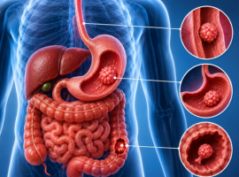 A New Option for Treating Early Gastrointestinal Tumors Without Major Surgery Banner