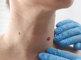 Advanced Skin Cancer Care with Mohs Surgery at St. Luke&rsquo;s Banner