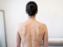 Advanced Mole Mapping and Hair Trichoscopy for Early Detection and Scalp Care