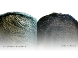 Experiencing Hair Loss? We've Got You Covered At Skin on the 7th Banner